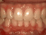 crowding-of-the-teeth-before