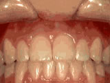 crowding-of-the-teeth-before