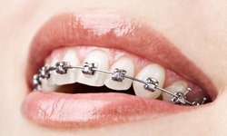 self-ligating-braces