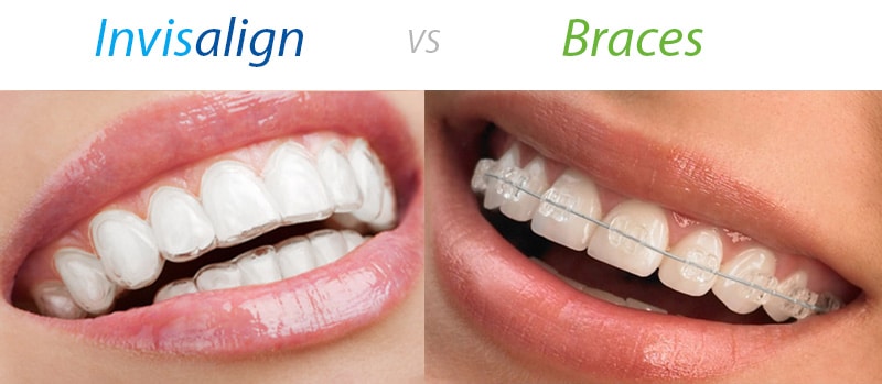 Invisalign vs. Braces Weighing the Pros and Cons mysmilect