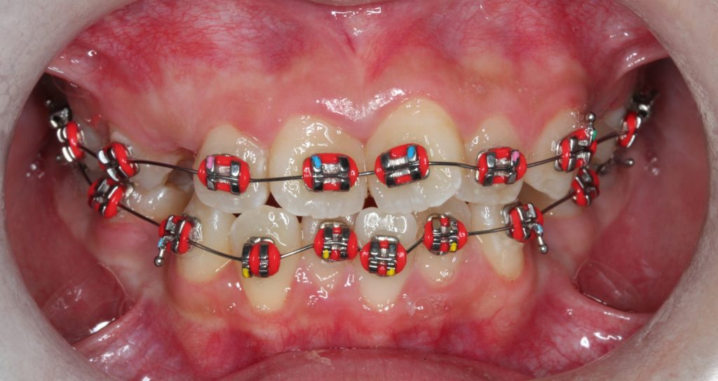 braces does hurt wearing getting feel wear care