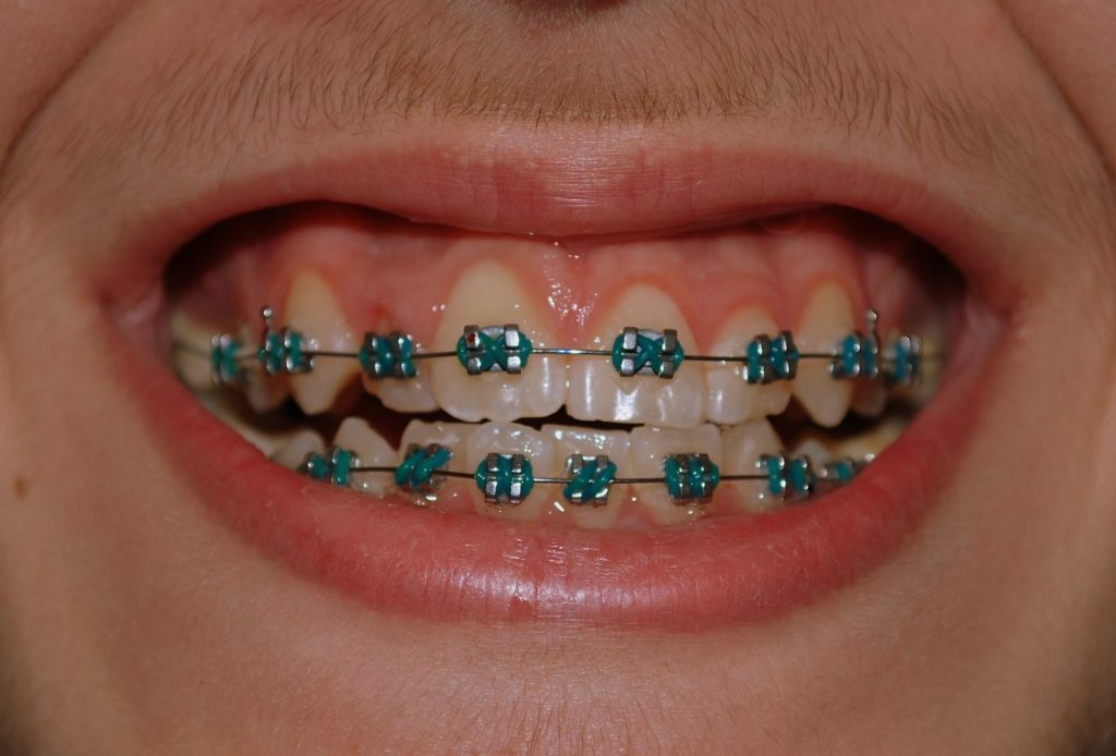 braces nhs wear feel does care wearing dental elastics coloured orthodontics age adults take still had orthodontic wires