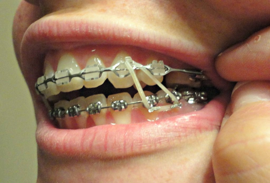 braces teeth broken wire bracket bands band does elastics should loose dental feel mouth rubber without bottom wearing open side