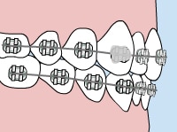 loose-bracket