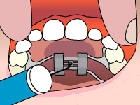 palatal-expander-step2