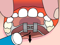 palatal-expander-step4