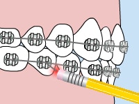 poking-wire