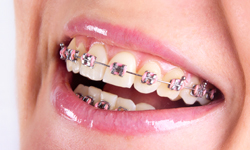 types of braces for teeth