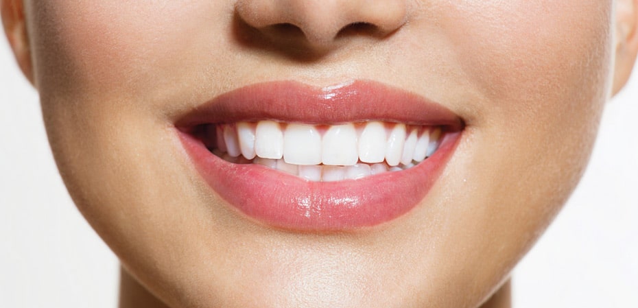 pros and cons of a permanent retainer mysmilect bonded retainer