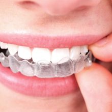 Invisalign Treatment After-Care