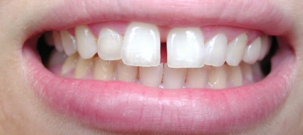 Spaces Between Teeth