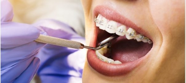 braces dental checkups