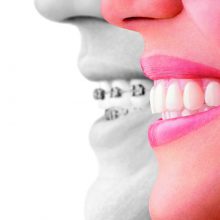 Invisalign Teen vs Invisalign Adults