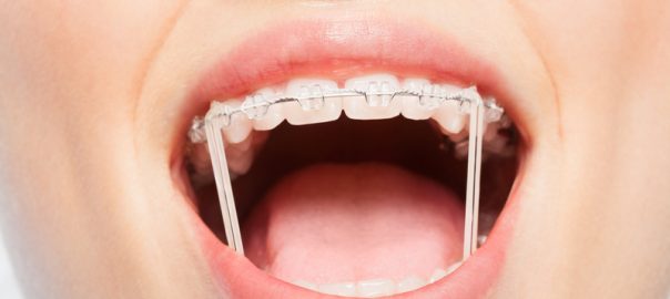 orthodontic elastics