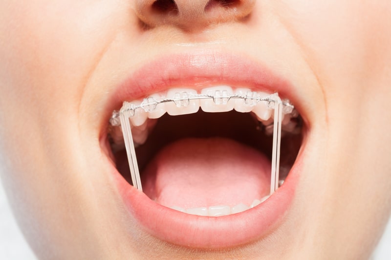 Orthodontic Elastics FAQs, WNY Orthodontists