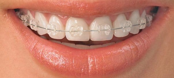 Affordable Braces