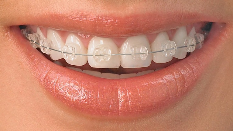 Affordable Braces Less Expensive Than You Think Mysmilect 