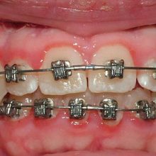 gum inflammation with braces