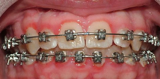 gum inflammation with braces